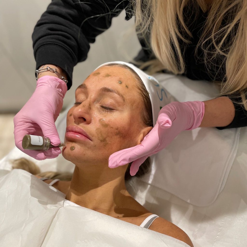 A skincare professional applying an SQT bio-microneedling facial treatment
