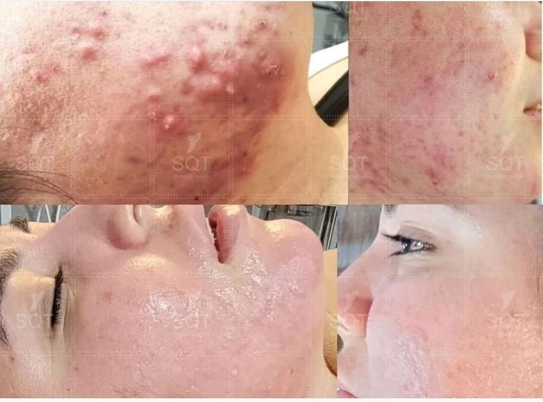 Before-and-after examples showing visible improvement in acne and skin texture